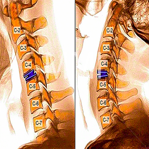Image of the spine after the Artificial cervical Disc Replacement (ADR).