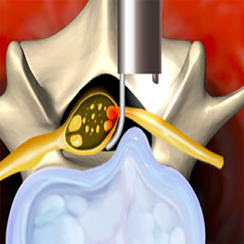 The image illustrates the Lumbar Disc Surgery.