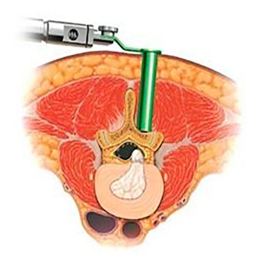 Image of Minimally Invasive Tube Assisted Lumbar Discectomy.