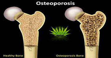 Image showing normal bone and Osteoporosis bone.