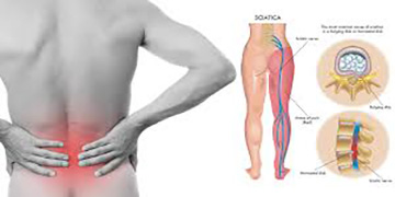 The collage image shows the pain from sciatica due to nerve compression.