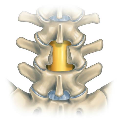 Depicts the Spine section where surgery for lumbar canal stenosis is performed.