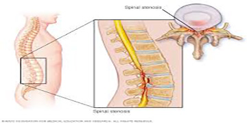 A collage image represents the spinal canal space narrowing in the spine for Lumbar Canal Stenosis.