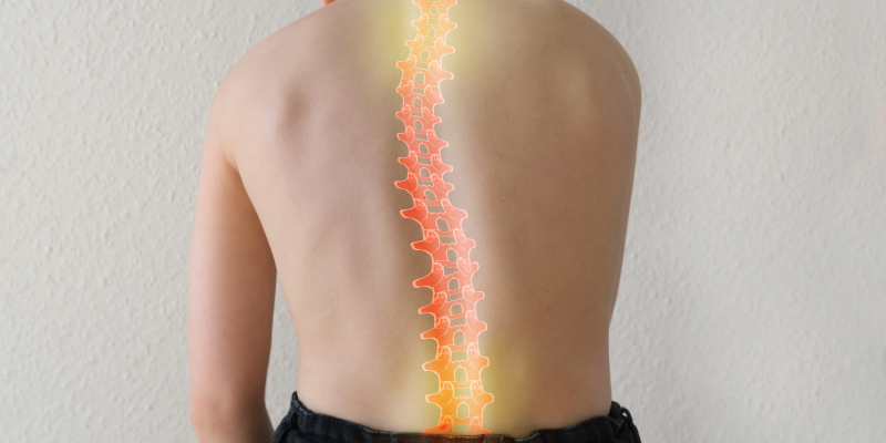 A boy child suffering from Scoliosis disease.